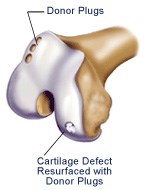 Diagram of an Osteochondral Autograft